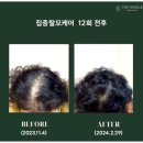 아유메디 | 더노블메디센터 부산 헤드스파 탈모예방 관리 받은 솔직 후기