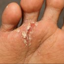 백선세탁 | 사타구니 백선 전염 가려움과 연고 후기