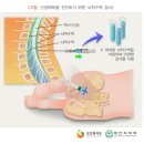 매독 증상/진단/치료 ;멘파워비뇨기과 인천점