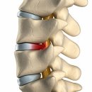 허리디스크, 수술없이 낫는법 이미지