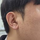 킴방울뷰티 | 피부색소개선 킴방울 방문후기 + 최근 변화 기록
