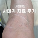 동백피부과의원 | 사마귀 5년 넘게 방치.. 동백 피부과에서 레이저 치료 후기