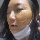 젠 | 코코리젠 내돈내산 후기 (기미,잡티,흑자 제거 후기 내돈내산)