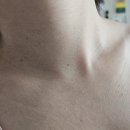 더나음홈케어 | 편평사마귀 동네 한의원에서 제거했다요