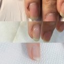 발닥터 | [발관리] 발관리 레전드 구미 발닥터!!!(비포에프터사진⭕️)
