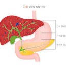 담도암 담관암 원인 생존율 이미지