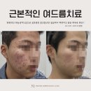 강동우성의원 | 강동구 여드름흉터 지우고 깨끗한 피부 만드는 노하우?