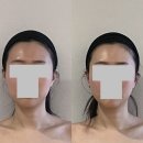 삼영이불집 | 위뷰티 예쁜 갸름 얼굴 피부관리 결혼준비 신부케어 후기