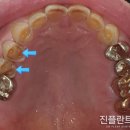 상아플란트치과 네이버블로그
