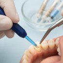 심미치과기공소 | 레진치료 가격부터 수명까지, 치과 가기 전 필독 (솔직 후기)