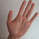 십자로약국 | 손 발 다한증 수술 교감신경 절제 차단술 클립술 후기