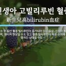 고빌리루빈혈증[hyperbilirubinemia]이란? 이미지