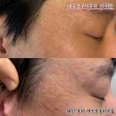 대구자연한의원 | 대구중구피부과 한의원 새살침 관자놀이 여드름흉터치료 리얼후기