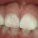 현치과의원 | 정보] 두 돌 아기 앞니 부딪힘 사고, 당진 어린이 치과 방문 및 불소도포 후기 (아홉가지약속 당진치과)
