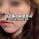 대구 수성구 시지피부과 자가혈피부재생주사 후기