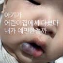 경희치과병원 | 15개월 아기 입안 봉합 후기 강동경희대 치과병원