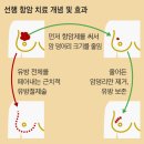 암 제거 수술은 마지막 단계… 이젠 항암 치료부터 한다 이미지