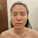 <하남/미사>명윤곽 윤곽관리 후기, 비대칭을 잡아라!!!