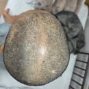 천안퍼스트힐요양병원 | [12] 허투양성 유방암 TCHP 항암 2차 후기