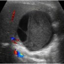 Gallbladder 이미지