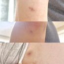 에스더의원 | 에스더의원, 피지낭종 제거 한달 후기.