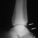 Impingement Syndromes of the Ankle 이미지