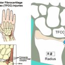 울산 박병원 - TFCC (삼각 섬유연골 복합체) 손상 이미지