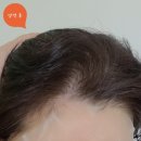 효심한의원 | 암환자 염색약 이문원한의원 새캄 저자극 눈시림NO:유방암 셀프염색 내돈내산 후기