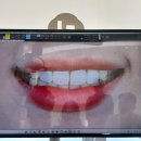 치아룸 치과기공소 | 연예인 치과로 유명한 강남 라미네이트 깨진 치아 상담 후기