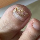 푸스케어 수원호매실점 | 영통 무좀발톱 푸스케어 수원영통점 영통 내성발톱 전문