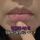 오투에스 | 드레스김원장 입술반점 시술후기