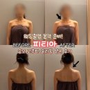 탐나다에스테틱 | 강남 예비신부 웨딩촬영전 드레스라인 관리 피티아 승모 관리 후기 압구정 에스테틱 추천