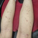 내성한의원 | 울산아토피한의원? 스테로이드 내성까지 생겨도 약을 못 끊는 분들께 드리는 편지