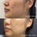 수(秀)테라피 | 마포구 최초 리베룩 입점 에스테틱, 수라움에스떼 "72K필름앰플" 론칭 선예약 이벤트