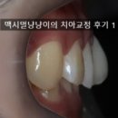 청치과의원 | [연세참예쁜치과] 동탄치과상담 앞니 부분교정 동탄교정후기 1 (앞니 틀어짐, 과개교합)