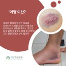 정읍부부한의원 | 부안 교통사고 한방병원 입원 놓치면 안되는 이유 3가지 │해빛 한의원