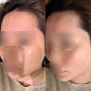 순피부과의원 | 압구정 리프팅 잘하는 피부과 에이포의원 온다 티타늄 온타늄 효과 후기