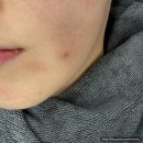 이대역 | 이대역 여드름 피부관리 후기, 김은영 코스메틱 내돈내산