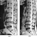 추간판탈출증 이미지