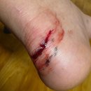 한마음외과의원 | 아이 자전거 사고 뒤꿈치 찢어짐.. 봉합 후기 (+치료비, 회복기간)