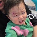 P-7512 | ​분당 아기 얼굴 상처 봉합 추천: 미금역 더나은성형외과 6개월 후 흉터 상태 변화
