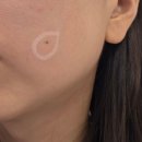 메이퓨어의원 | 광명역 메이퓨어 의원 비립종, 점 제거, 인모드 내돈내산 후기