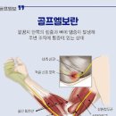 골프엘보 통증 증상 원인 예방법 이미지