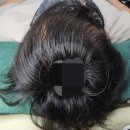 소호헤어샾 | 화정헤어증모술 ㅡ남성 앞머리엠자탈모
