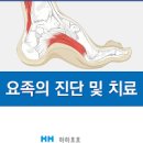 요족 및 (발아치 통증, 발통증) 이미지