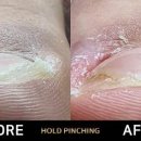 홀드핀칭 이미지