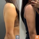 365엠씨람스의원 | [02미용] 팔뚝람스후기_시술 3,4주차_영등포365mc