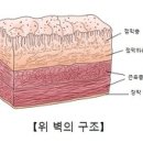 위선종 (Gastric Adenoma) 이미지