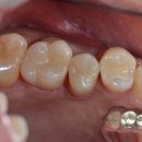 모델리스 치과기공소 | MOUNT :D(마운트 디) 치과기공소 크라운 모음.ZIP