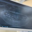 연세플라워치과병원 | 세브란스 연세대학교 치과대학병원 사랑니 발치 후기